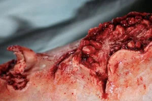 ForensicFX Studios Dog Bite Wound Prosthetic> Halloween Accessories