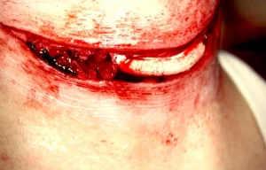 ForensicFX Studios Exposed Slit Throat Prosthetic> Halloween Accessories