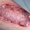 ForensicFX Studios Infected Medical Skin Graft Prosthetic> Halloween Accessories