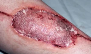 ForensicFX Studios Infected Medical Skin Graft Prosthetic> Halloween Accessories