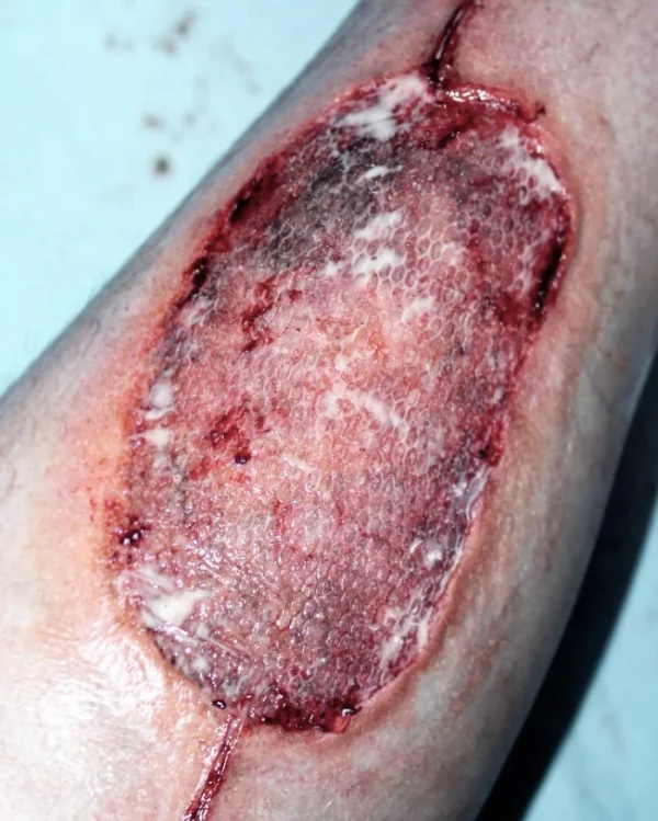 ForensicFX Studios Infected Medical Skin Graft Prosthetic> Halloween Accessories