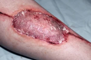 ForensicFX Studios Infected Medical Skin Graft Prosthetic> Halloween Accessories