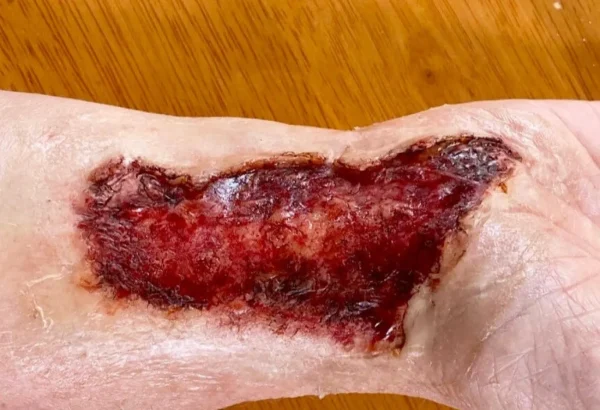 ForensicFX Studios Skin Burn Prosthetic> Halloween Accessories