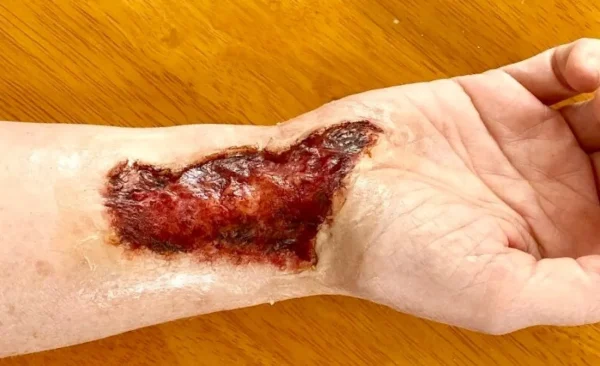 ForensicFX Studios Skin Burn Prosthetic> Halloween Accessories