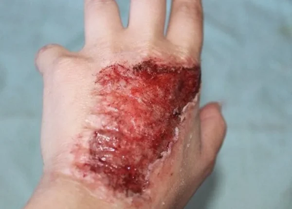 ForensicFX Studios Skin Burn Prosthetic> Halloween Accessories